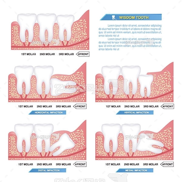 وکتور دندانپزشکی و دندان عقل