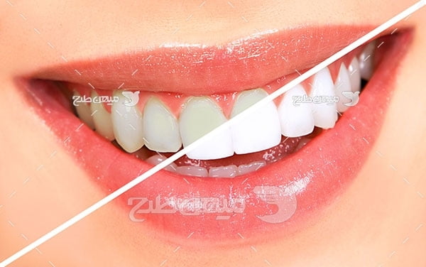 عکس تبلیغاتی دندان پزشکی و لمینت