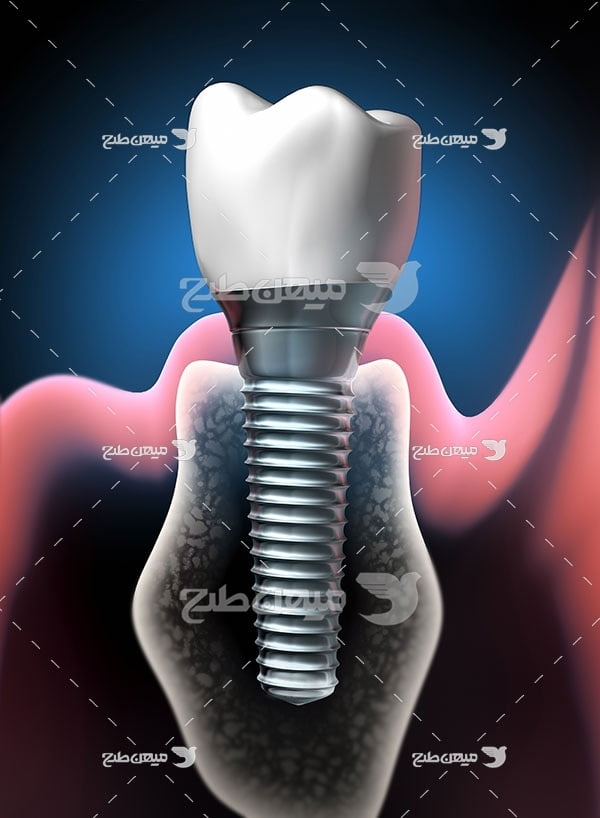 عکس تبلیغاتی پزشکی ایمپلنت دندان