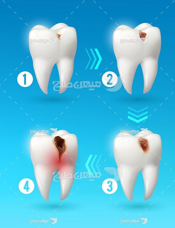 وکتور مراحل تخریب دندان