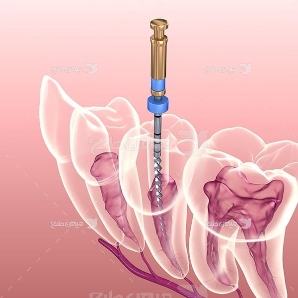 عکس عصب کشی دندان