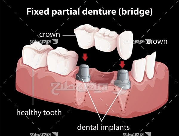 وکتور گرافیکی دندان دندان مصنوعی