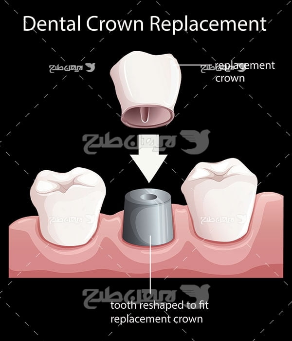 وکتور گرافیکی دندان مصنوعی