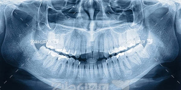  رادیوگرافی دندان