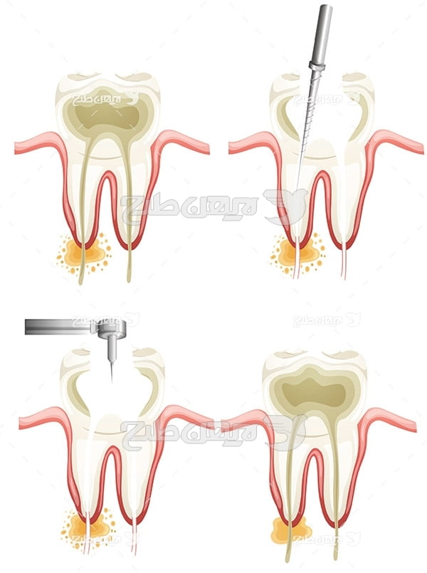 وکتور گرافیکی درمان دندان