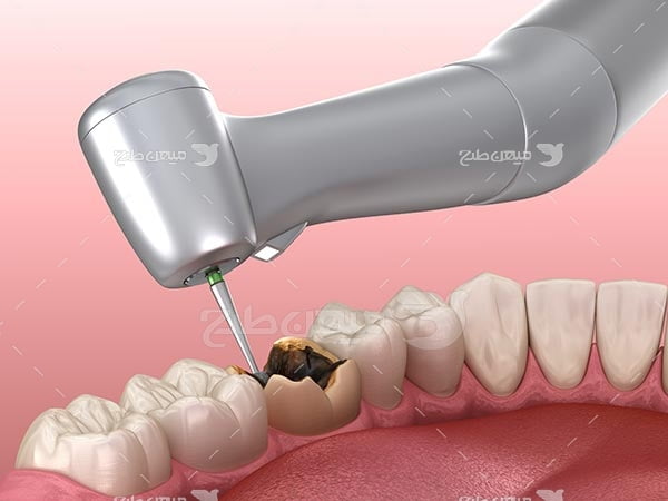 عکس ترمیم دندان