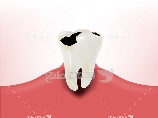 وکتور دندان آسیب دیده